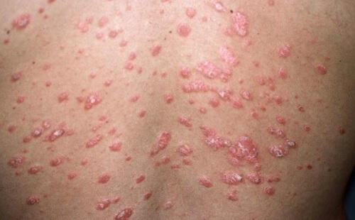 What Is Psoriasis and What Are the Different Kinds? - Step To Health