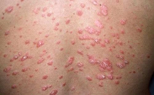 What Is Psoriasis and What Are the Different Kinds?