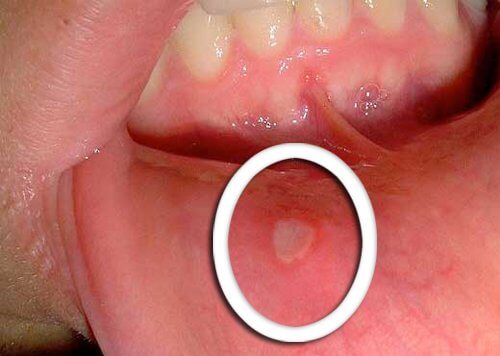 Sores in the mouth can be a symptom of oropharyngeal cancer.