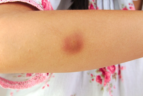 Purple bruise on arm uses for Vicks Vaporub