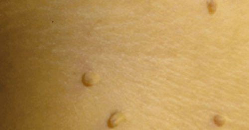 Warts on the skin uses for vicks vaporub
