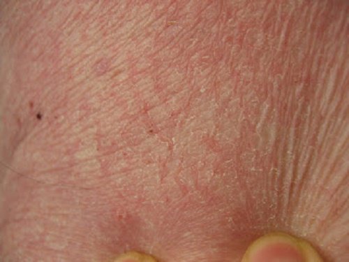 dry skin one of the early signs of hypothyroidism