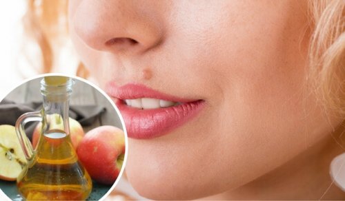 How to Remove Moles Naturally