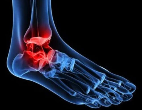 Ankle osteoarthritis symptoms are painful