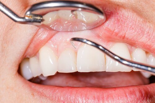 7 Natural Solutions to Relieve Swollen Gums