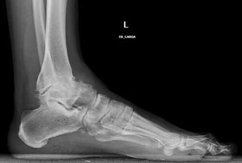 Ankle osteoarthritis symptoms at x-ray