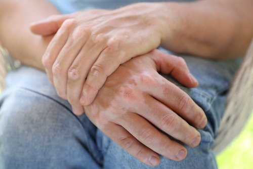 Natural Remedies for Vitiligo