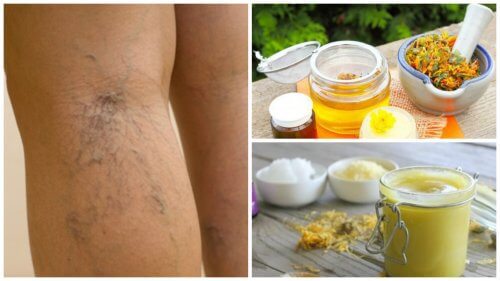 How to Use Arnica Ointment to Treat Varicose Veins