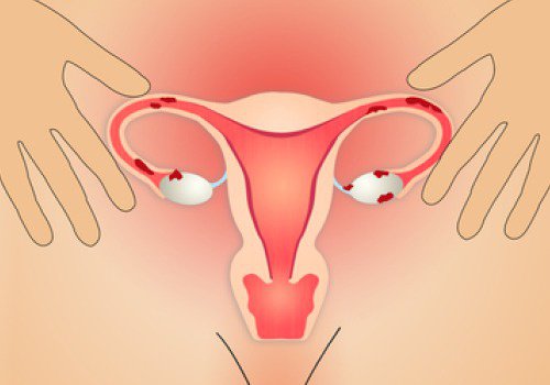 5 Natural Remedies for Symptoms of Endometriosis
