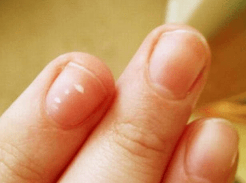 fingernails with white spots