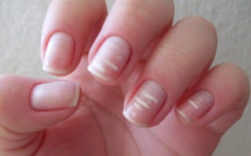 fingernails with white spots
