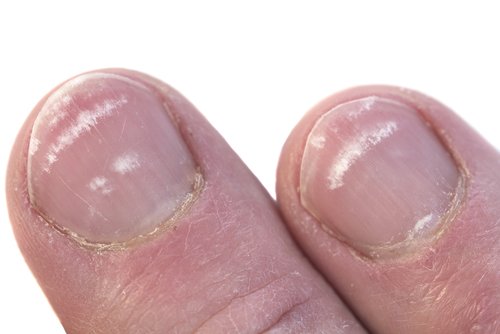 White Spots on the Nails: Where do They Come From?