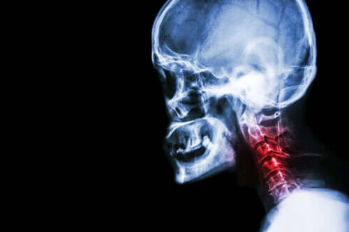 The Symptoms of Cervical Spondylosis and Natural Treatments