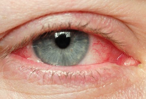 When you're not drinking enough water, your eyes may get red.