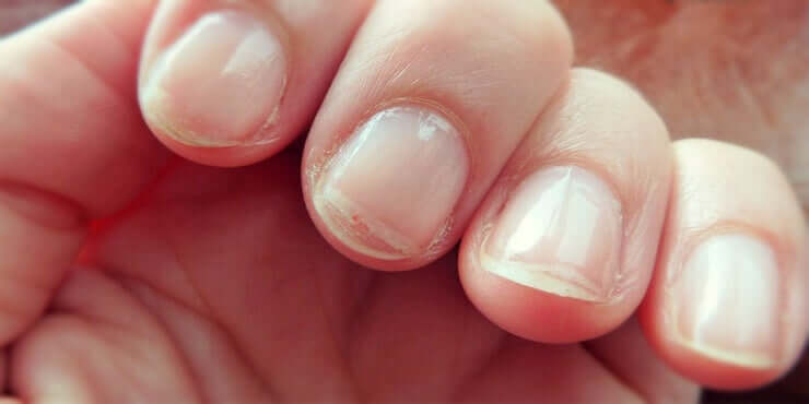 Droge en schilferende nagels