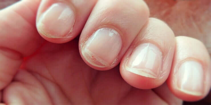 Dry and flaky fingernails.