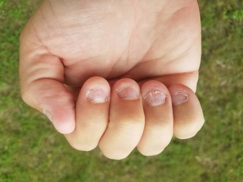 A hand with extremely short fingernails due to nail biting. 