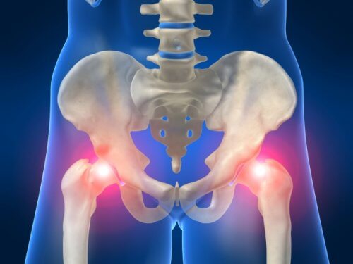 Osteoarthritis.