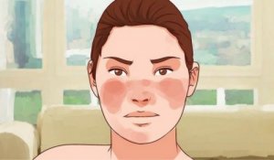 7 Remedies for Controlling Lupus