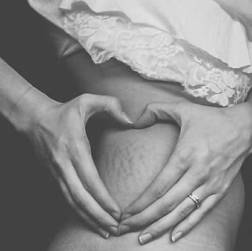 A woman showing her stretch marks.