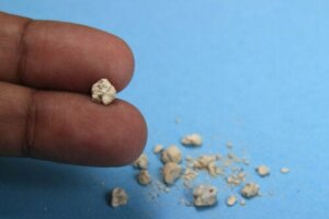 Five Types of Food that Cause Kidney Stones