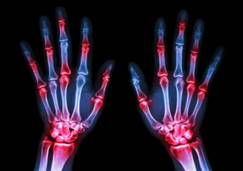 Five Symptoms of Rheumatoid Arthritis