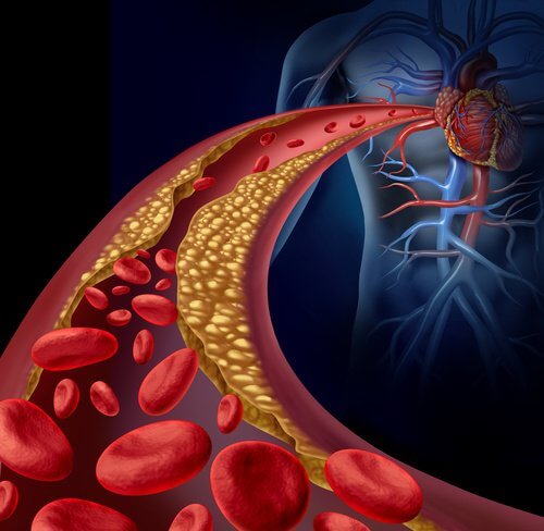 Blocked arteries and blood vessels