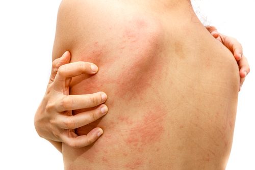 Natural Home Remedies to Treat Hives