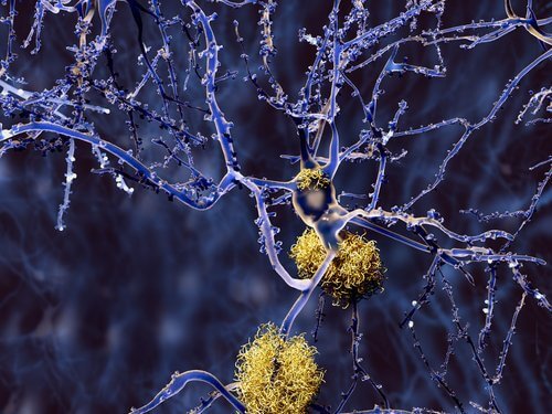 alzheimerin tauti