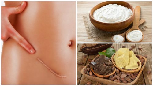 Seven Natural Remedies for Reducing Scars