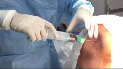 Bone marrow extraction