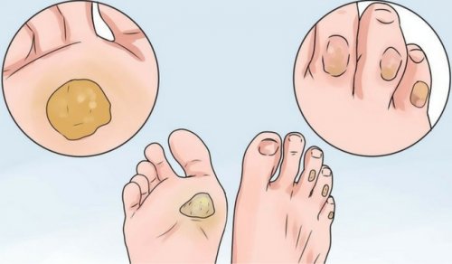 10 Remedies to Say Goodbye to Calluses and Blisters