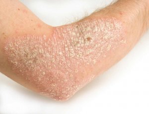 Help Your Psoriasis with These 6 Easy Natural Remedies
