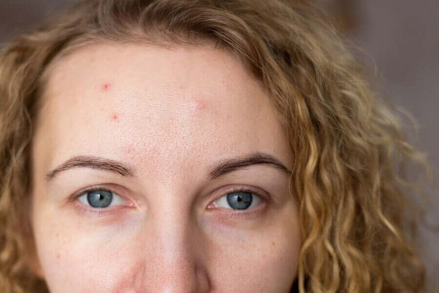 A woman with acne.