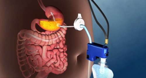 1 obesity treatment