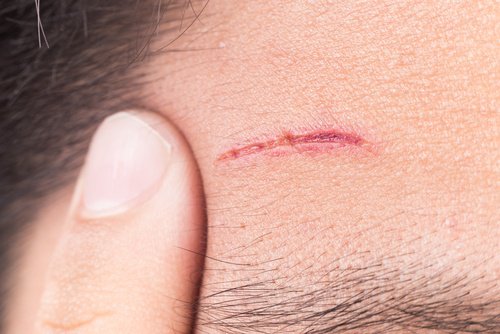 Healing wound