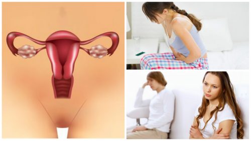 7 Things You Should Know About Polycystic Ovary Syndrome 7 Things You Should Know About Polycystic Ovary Syndrome