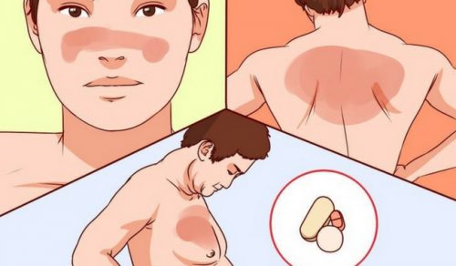 What You Should Know About Lupus