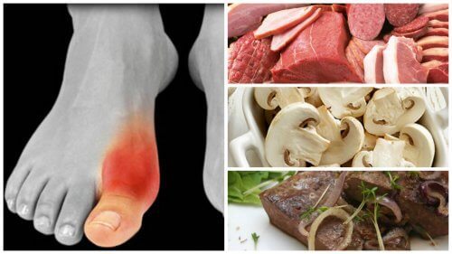 Do You Suffer from Gout? Avoid These 7 Foods