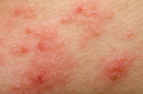 9 Natural Remedies for Rosacea