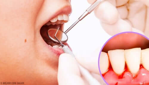 Gingivitis.