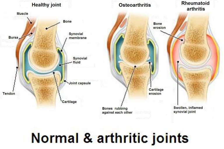 Osteoarthritis, Osteoporosis and Arthritis: What Are the Differences?