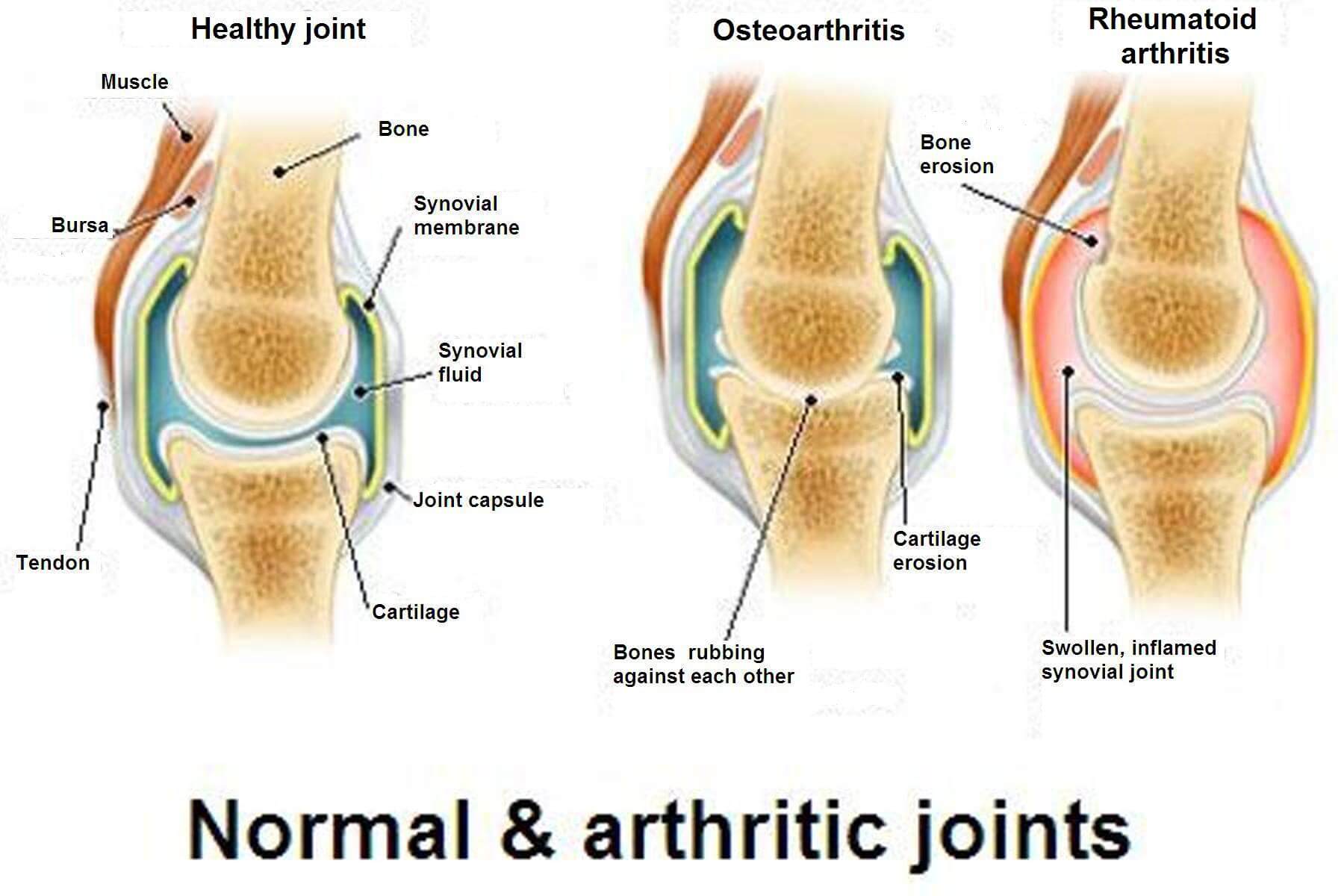 The Differences between Arthritis, Osteoarthritis, and Osteoporosis The Differences between Arthritis, Osteoarthritis, and Osteoporosis