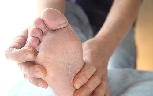 Foot with dry and cracked skin