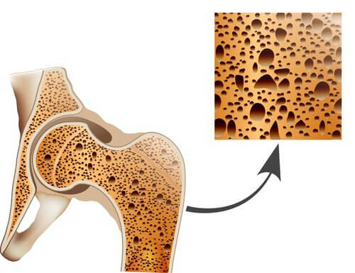 porous bone
