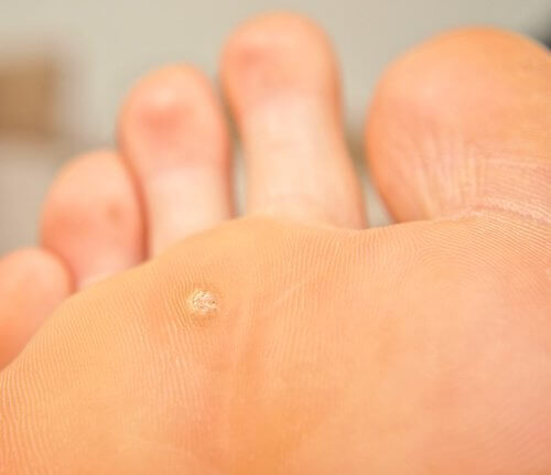 Foot with a wart