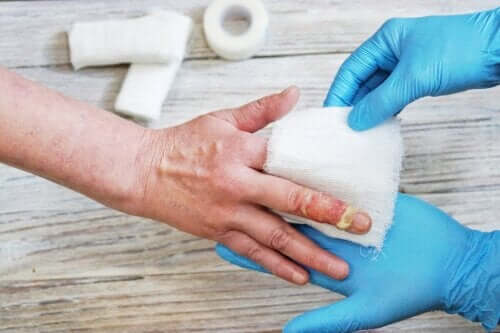 First Aid Treatment for Hot Water Burns