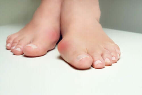 Seven Effective Ways to Relieve Bunion Pain