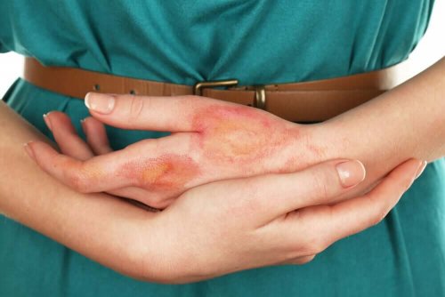 A woman with a burnt hand.