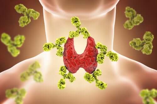 Six Things You Need to Know about Hashimoto's Thyroiditis